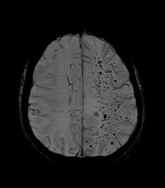 Example of cerebral microbleeds on susceptibility-sensitive MRI