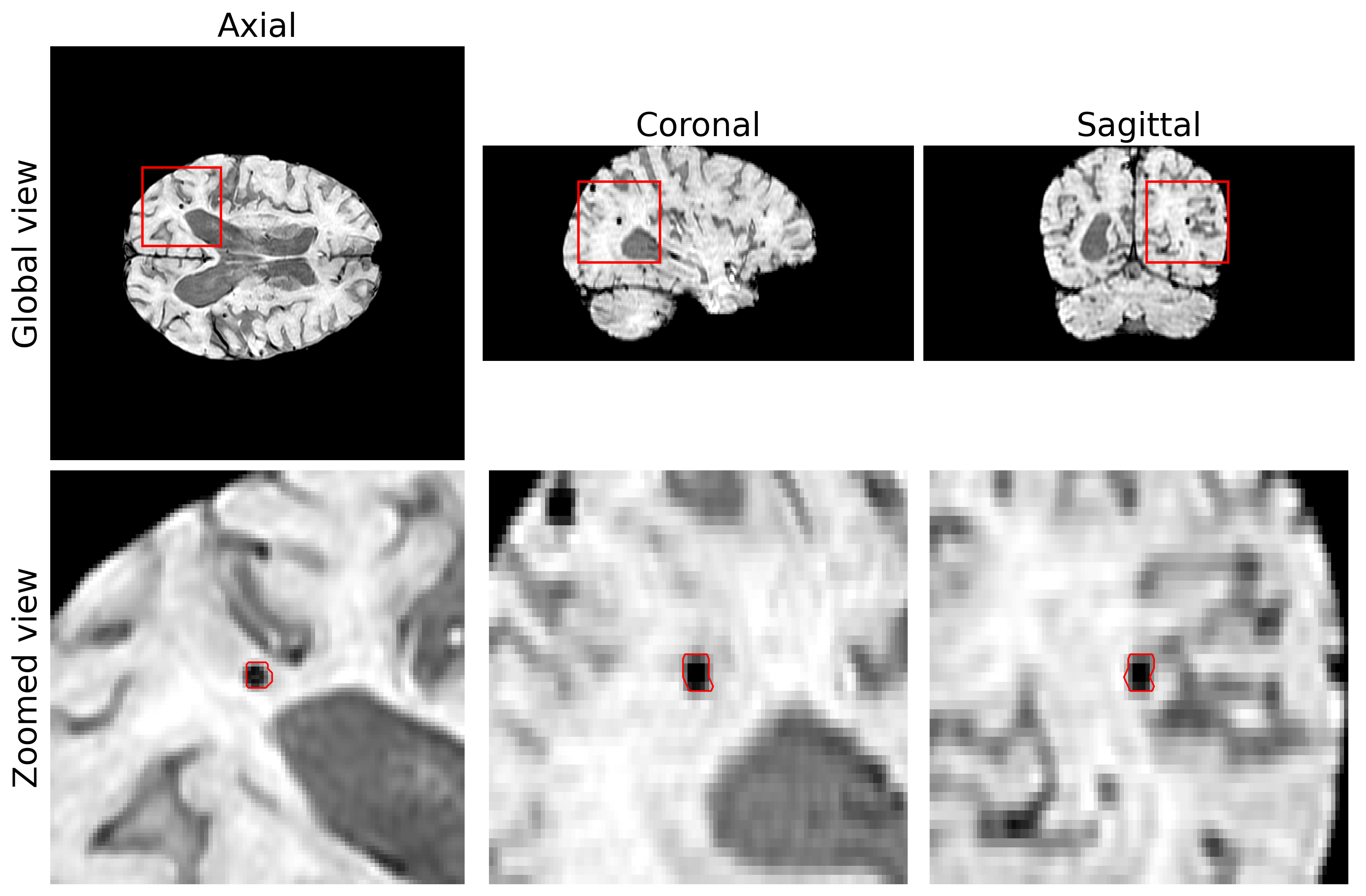 Real cerebral microbleed example