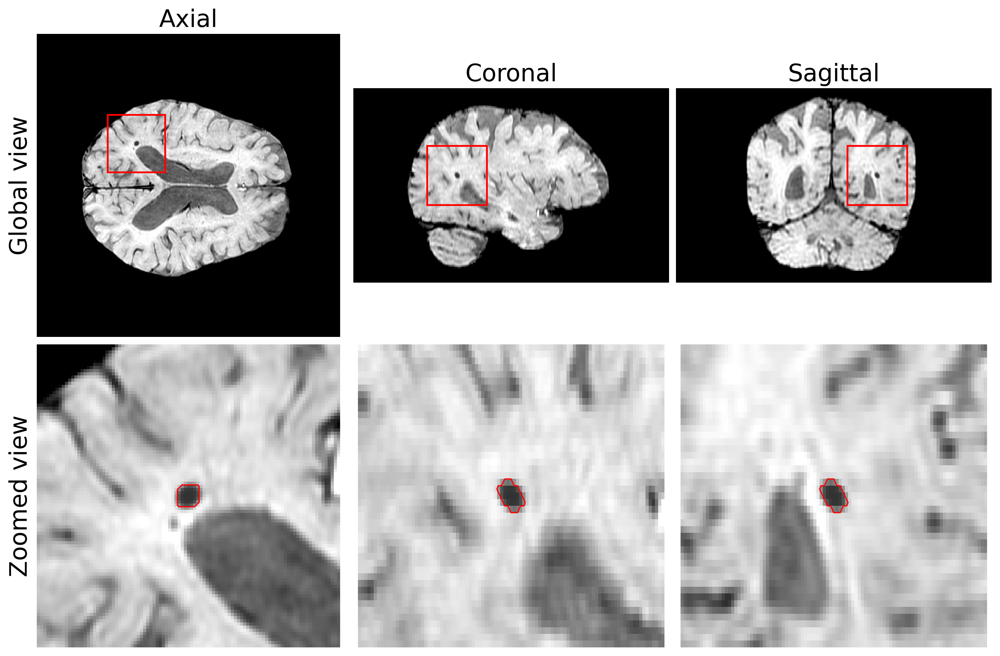 Synthetic cerebral microbleed example